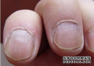 灰指甲的危害